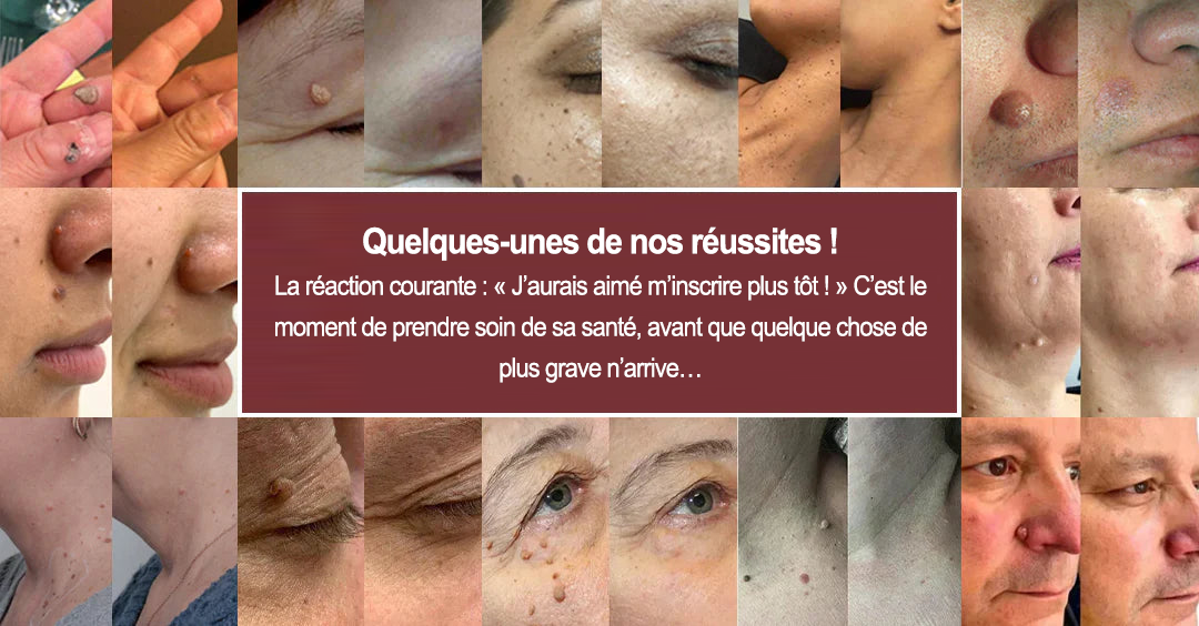 🏥 Curalona® Patch Invisible 2-en-1 🍀 | Cible les acrochordons, verrues planes et petites imperfections visibles | Micro-aiguilles + hydrocolloïde | Sans coupure • Sans congélation • Visage & corps