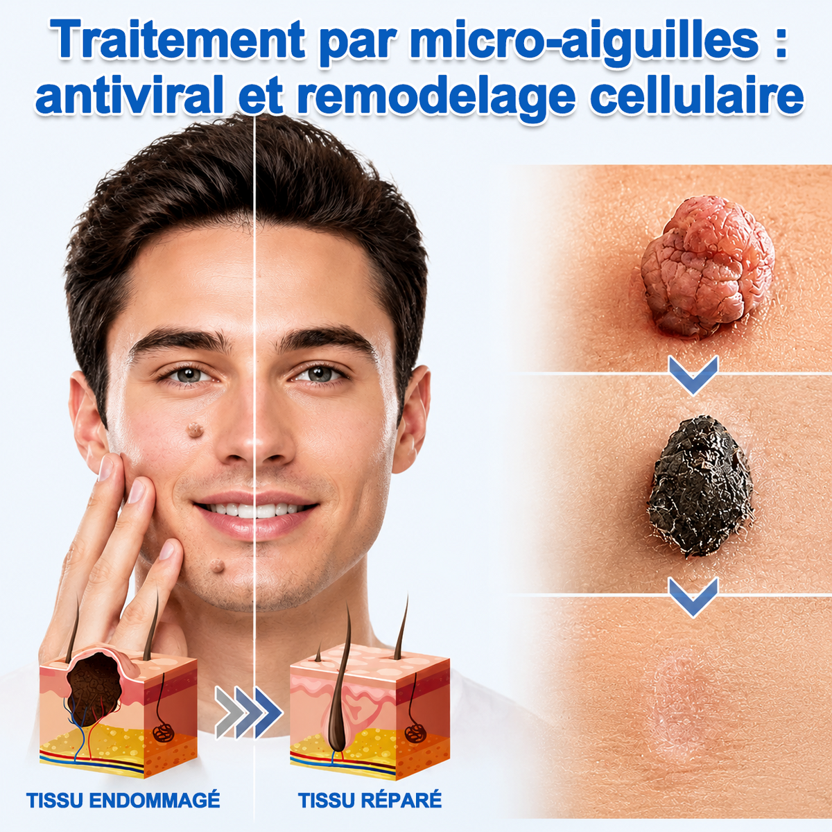 🏥 Curalona® Patch Invisible 2-en-1 🍀 | Cible les acrochordons, verrues planes et petites imperfections visibles | Micro-aiguilles + hydrocolloïde | Sans coupure • Sans congélation • Visage & corps