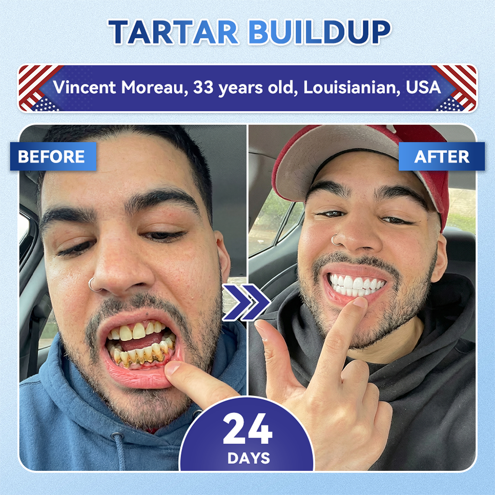 🏥 Pharmacie en ligne | Purelora® 😁 Bandes buccales à dissolution rapide au Tideglusib pour la réparation des dents et des gencives 🦷