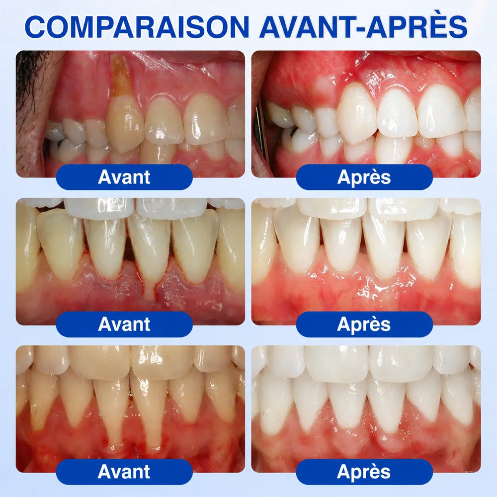 🧑‍⚕️🦷Purelora®  GumRevive Gel Réparateur Parodontal ✨