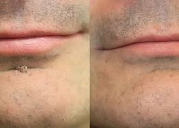 🏥 Curalona® Patch Invisible 2-en-1 🍀 | Cible les acrochordons, verrues planes et petites imperfections visibles | Micro-aiguilles + hydrocolloïde | Sans coupure • Sans congélation • Visage & corps