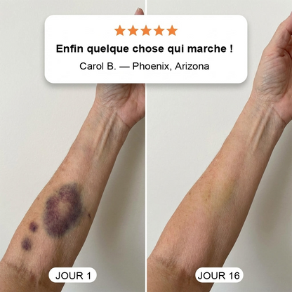 100K+ SOLD💕- PURELORA® Bruise Repair & Skin-Strengthening Cream