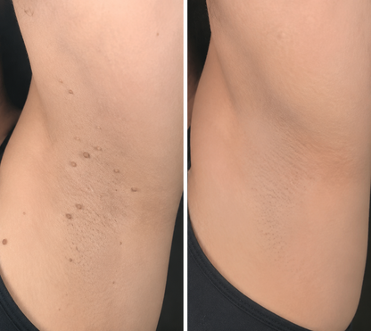 🏥 Curalona® Patch Invisible 2-en-1 🍀 | Cible les acrochordons, verrues planes et petites imperfections visibles | Micro-aiguilles + hydrocolloïde | Sans coupure • Sans congélation • Visage & corps