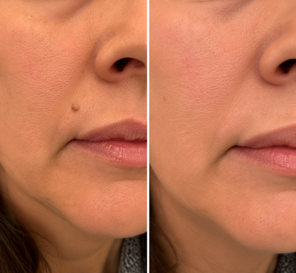 🏥 Curalona® Patch Invisible 2-en-1 🍀 | Cible les acrochordons, verrues planes et petites imperfections visibles | Micro-aiguilles + hydrocolloïde | Sans coupure • Sans congélation • Visage & corps