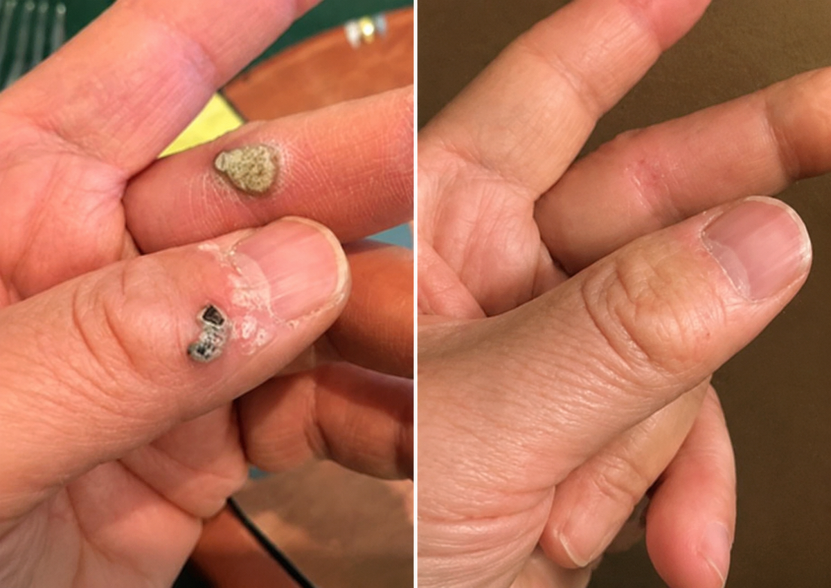 🏥 Curalona® Patch Invisible 2-en-1 🍀 | Cible les acrochordons, verrues planes et petites imperfections visibles | Micro-aiguilles + hydrocolloïde | Sans coupure • Sans congélation • Visage & corps